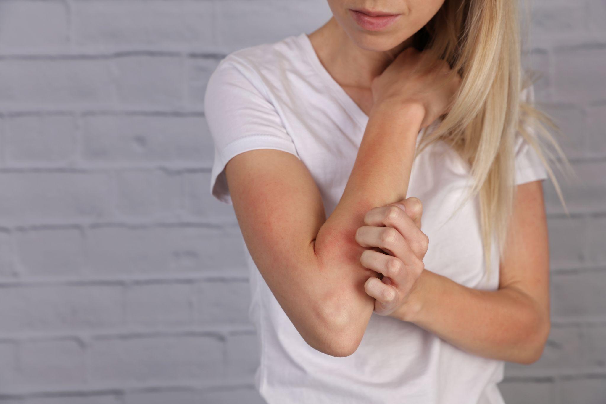 5 Tips to Take Action Against Psoriasis